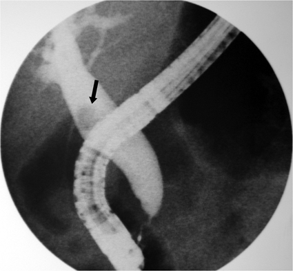 common bile duct stone. dilatated common bile duct