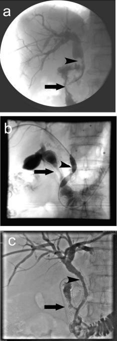 common bile duct obstruction. common bile duct lesions.