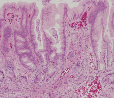 Giant Gastric Antral Ulcer Developing After Short-Term NSAID ...