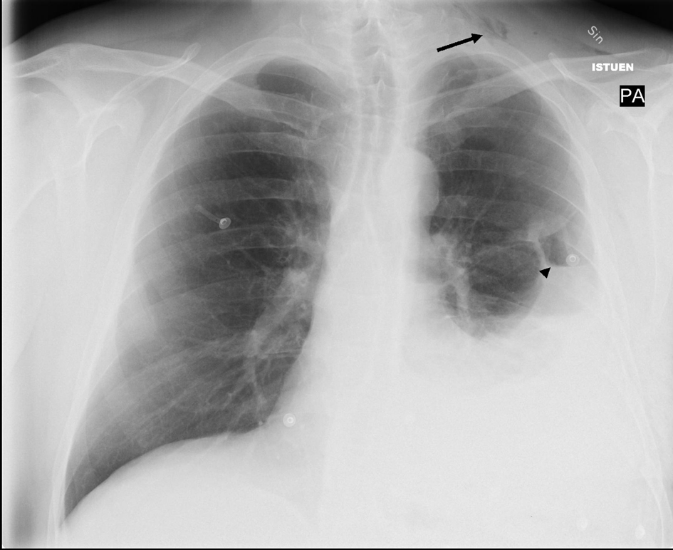 apical pneumothorax chest x ray